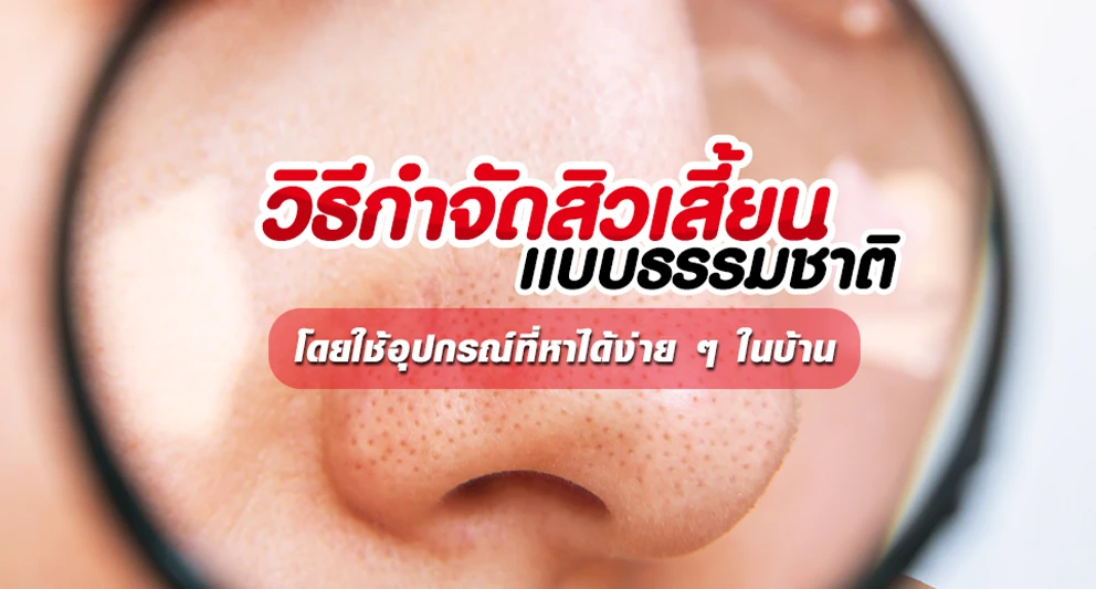วิธีกำจัดสิวเสี้ยนแบบธรรมชาติ-โดยใช้อุปกรณ์ที่หาได้ง่ายๆ-ในบ้าน
