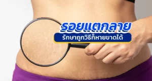 รอยแตกลาย รักษาถูกวิธีก็หายขาดได้