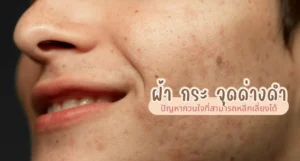 ฝ้า กระ จุดด่างดำ