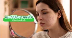รักษารอยสิว